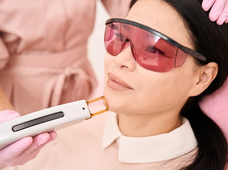 Acne Scarring Treatment in London