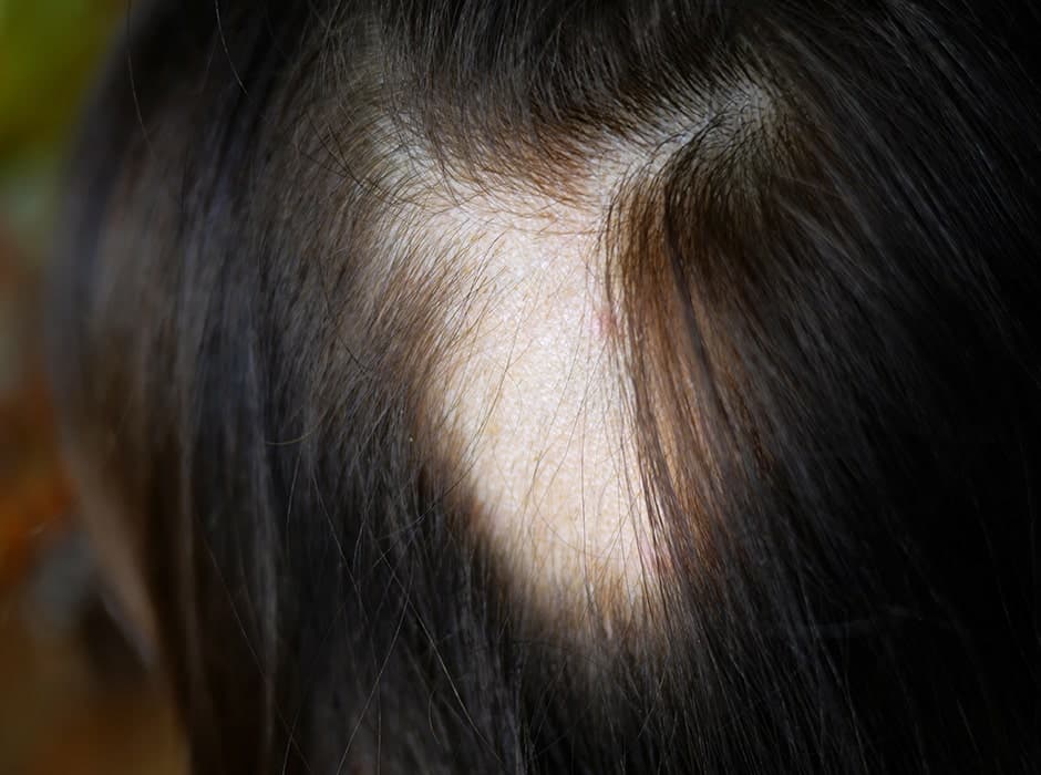 Alopecia Treatment London