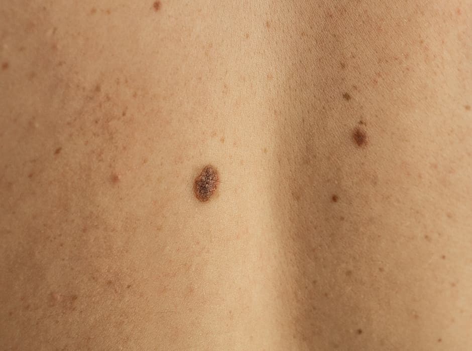 Liver Spot Removal in London