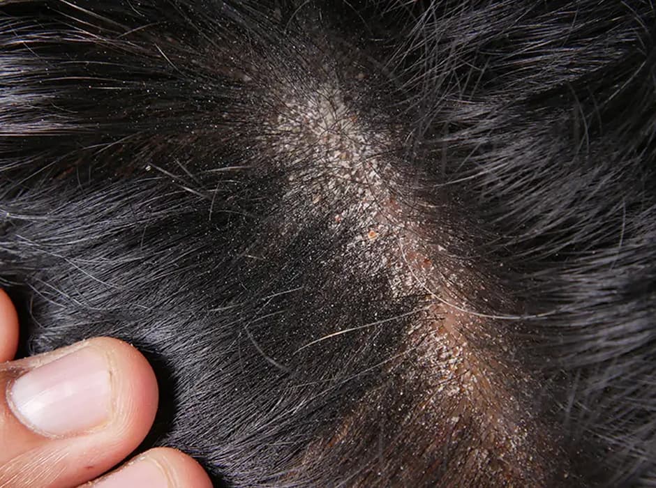 Scalp Dermatologist London