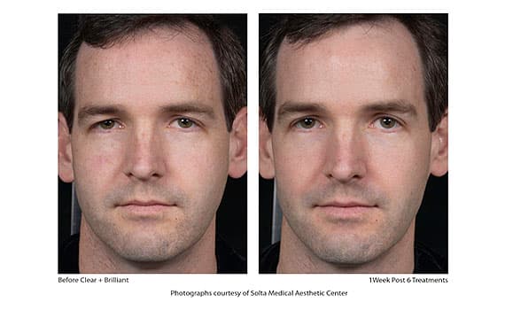 Before and after Clear + Brilliant laser treatment, male patient, 1 week post 6 treatments