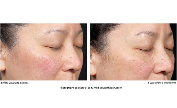 Before and after Clear + Brilliant laser treatment, female patient, 1 week post 6 treatments