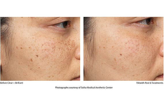 Before and after Clear + Brilliant laser treatment, 1 month post 6 treatments