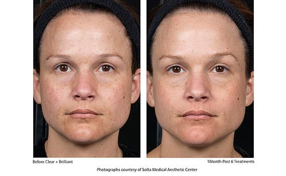 Before and after Clear + Brilliant laser treatment, 1 month post 6 treatments