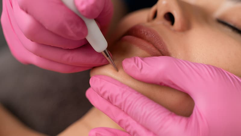 Curettage and Cautery