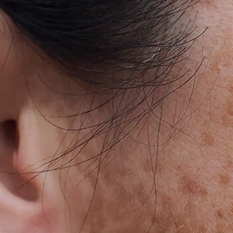 Liver spots on skin