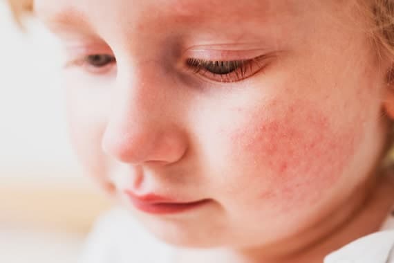 Contact dermatitis and atopic eczema in children