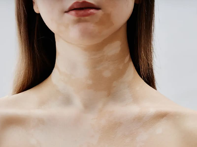 Skin condition affecting the neck and chest