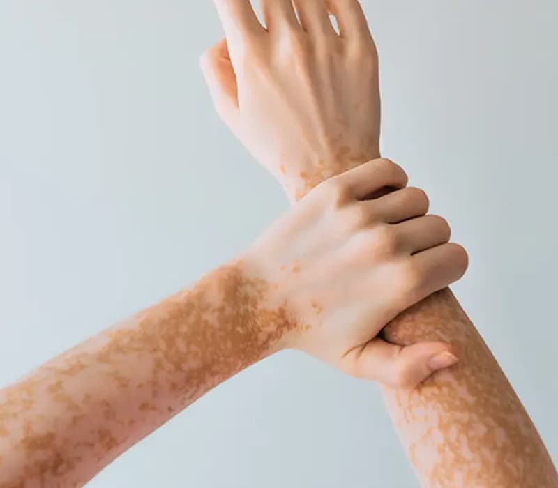 Vitiligo affecting the hands and arms