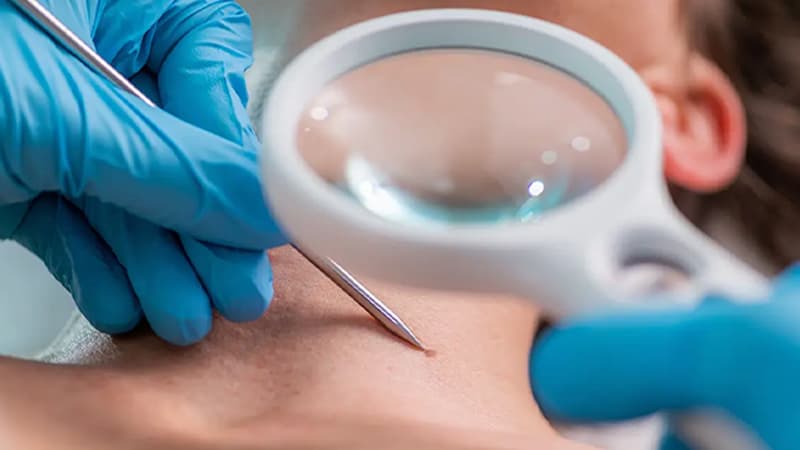 Surgical Excision