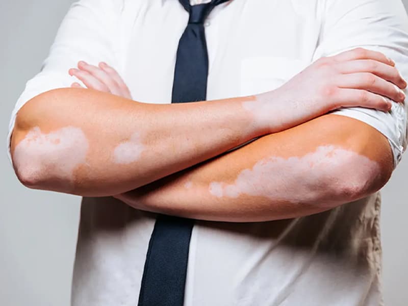 Vitiligo affecting the arm