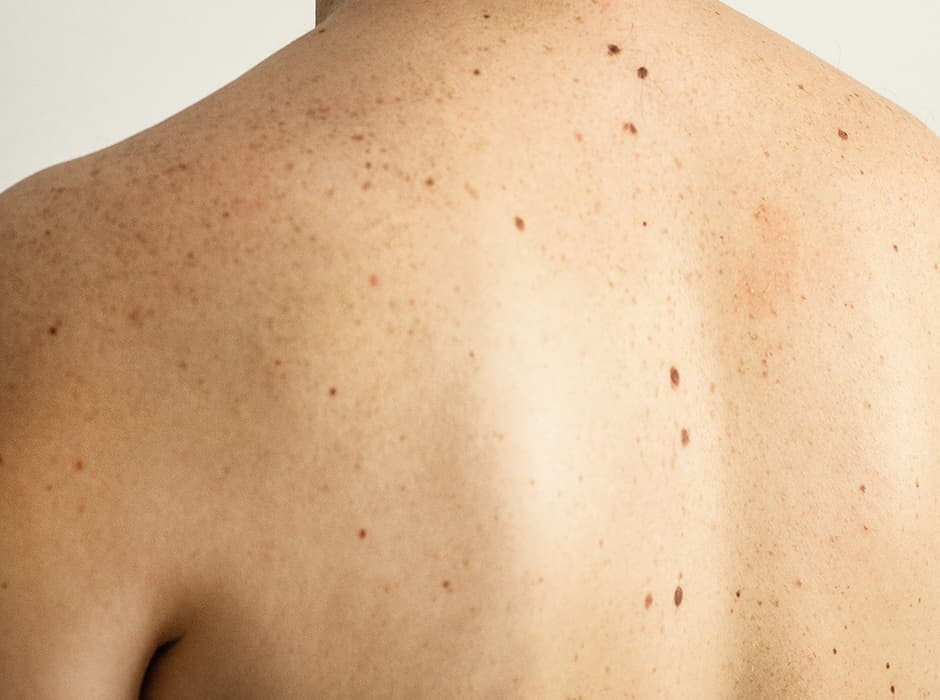 Age Spots (Solar Lentigos) Treatment