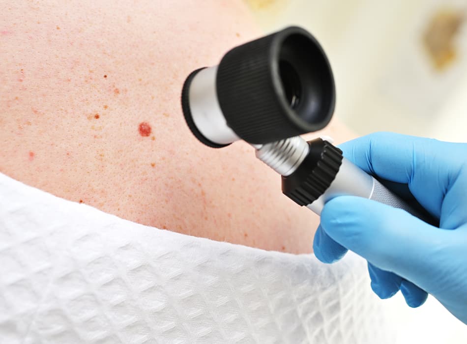 Basal Cell Carcinoma Treatment London