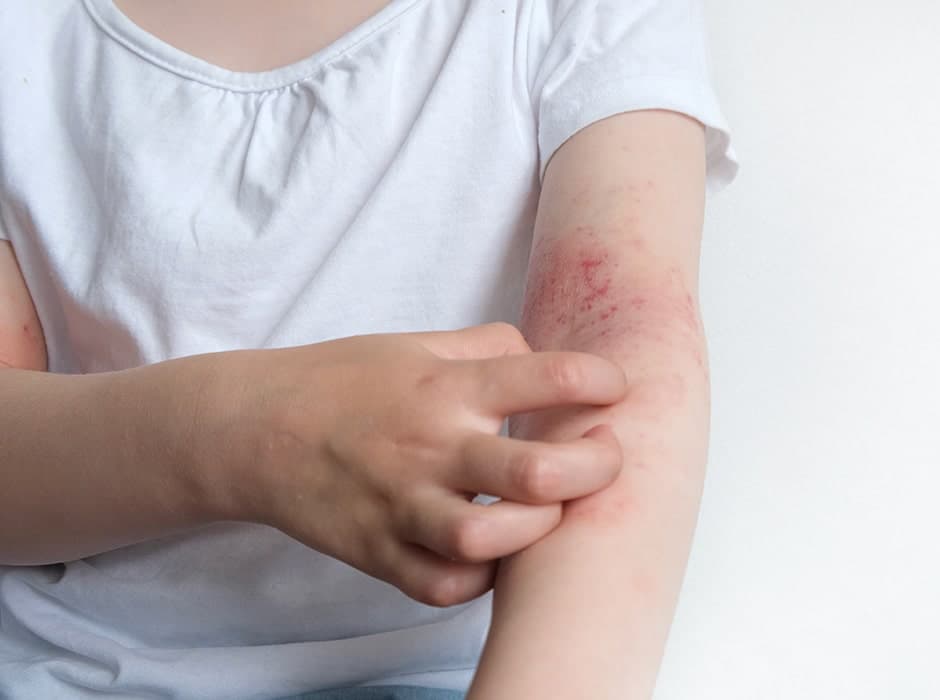 Eczema Treatment in London