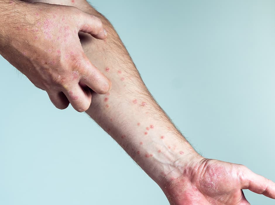Scabies Treatment in London