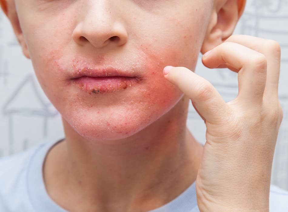 Private Seborrhoeic Dermatitis Treatment