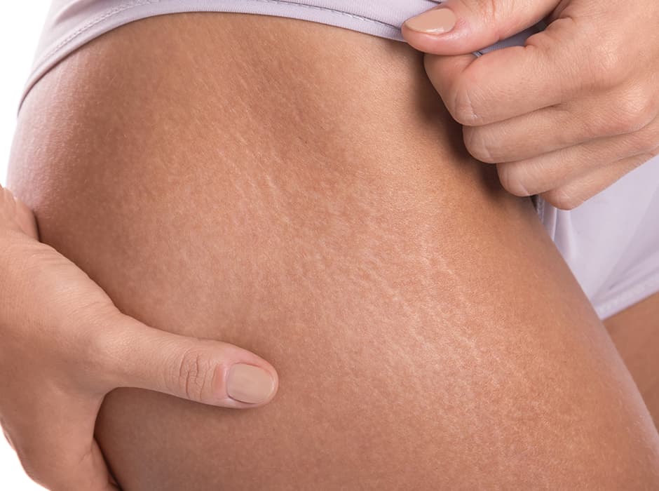 Stretch Marks Treatment London