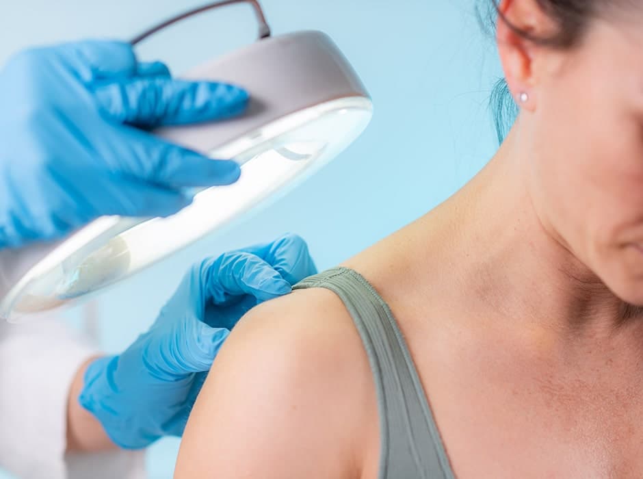 Sebaceous Cyst Removal in London