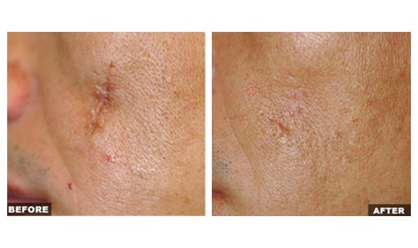 Before and after Fraxel laser treatment, scarring improvement