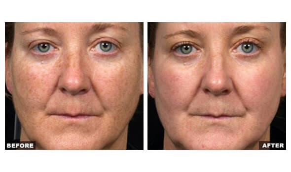 Before and after Fraxel laser treatment, skin rejuvenation