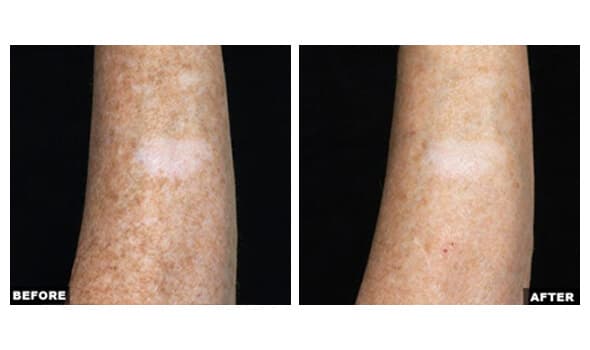 Before and after Fraxel laser treatment, wrinkles and texture improvement