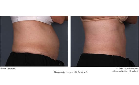 Before and after Liposonix treatment