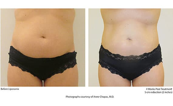 Before and after Liposonix treatment