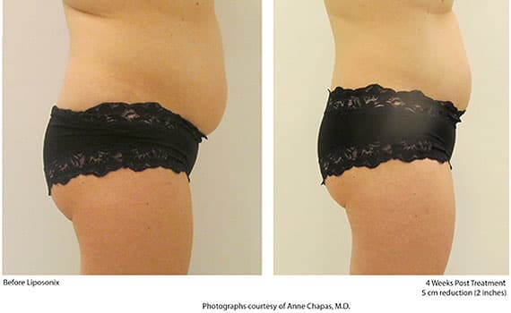 Before and after Liposonix treatment