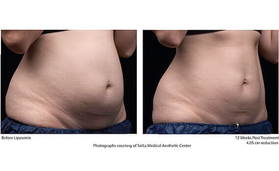 Before and after Liposonix treatment