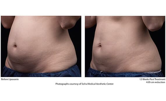 Before and after Liposonix treatment
