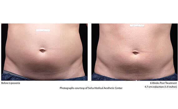 Before and after Liposonix treatment