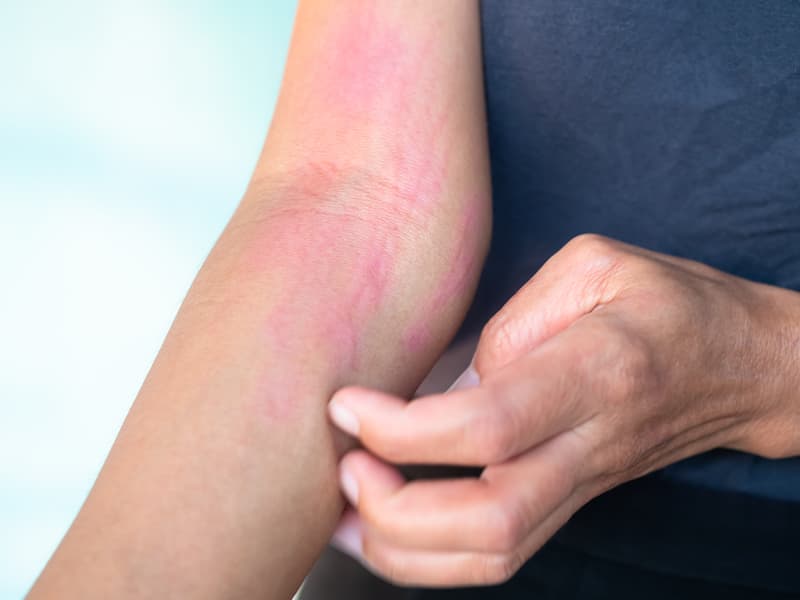 Age spot on skin