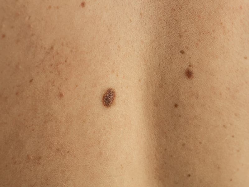 Age spot on skin