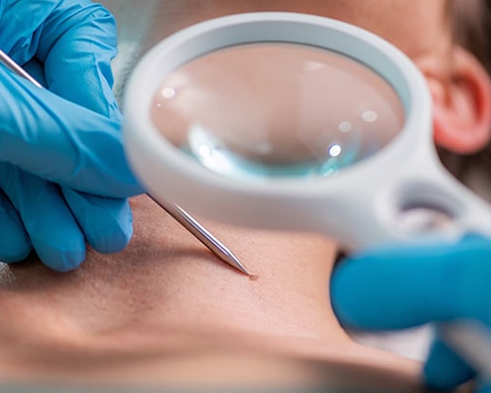 Why Choose Mohs Surgery