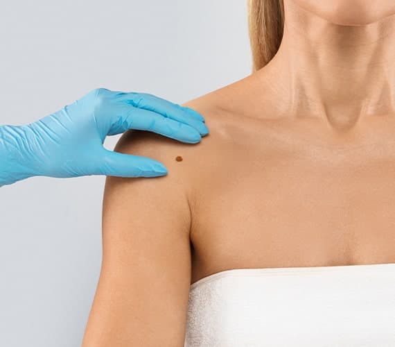 Mole removal treatment options