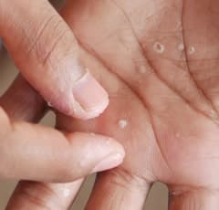 Pustular Psoriasis