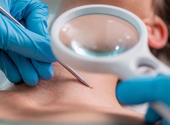 Mole removal procedures