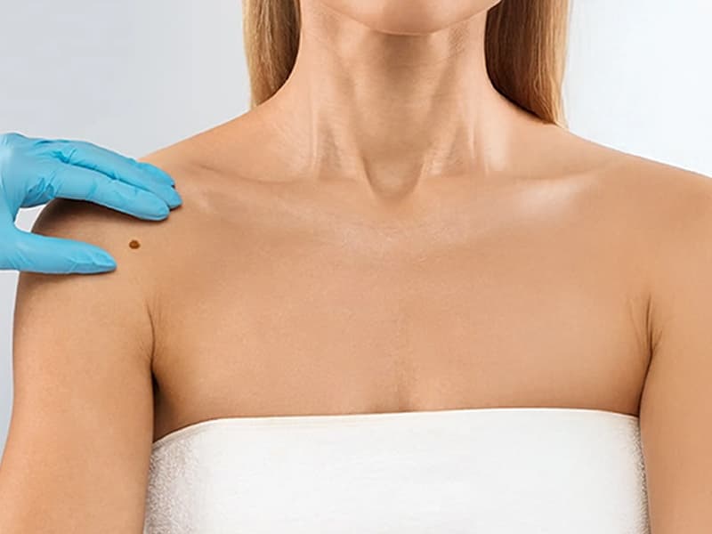 Moles (Benign, Atypical or Suspicious)