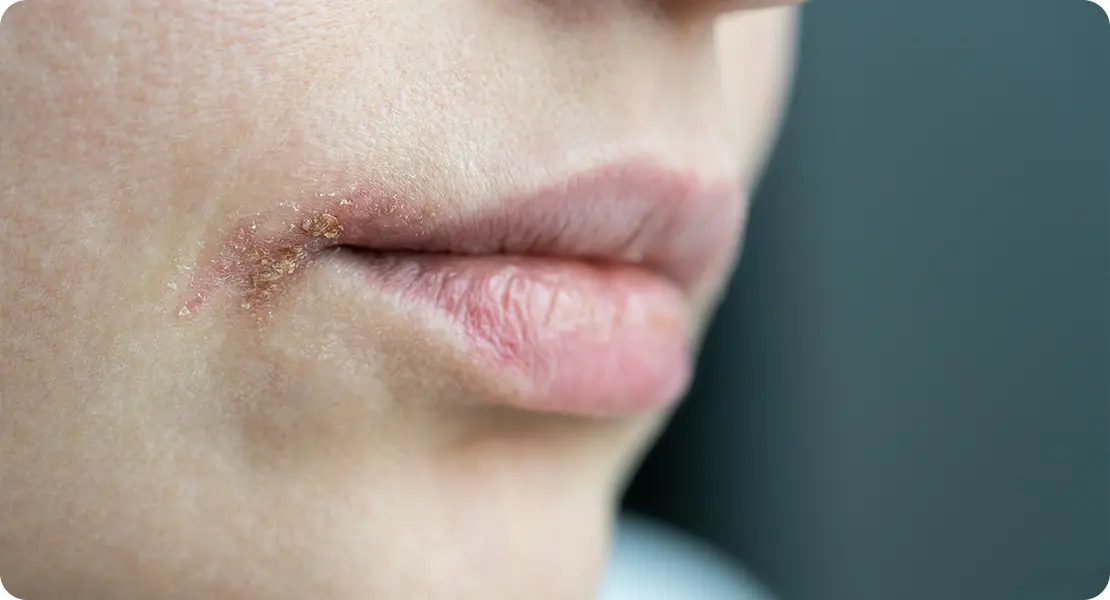 Lips herpes 3