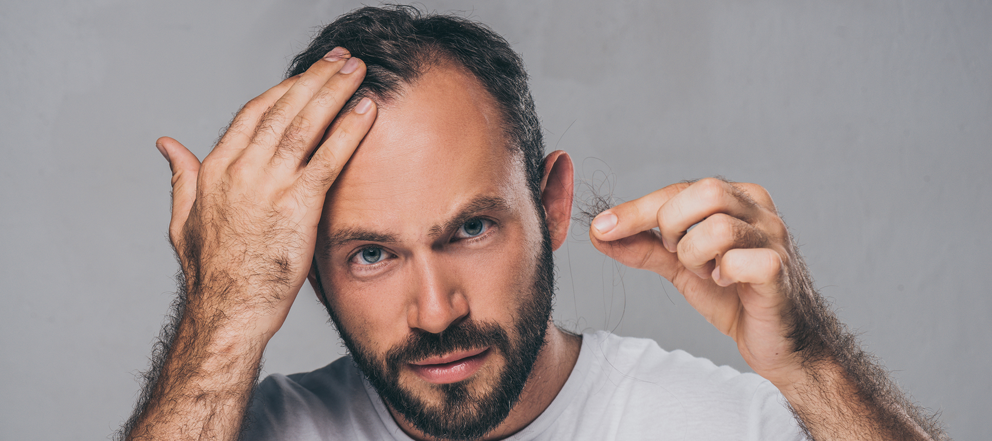 alopecia