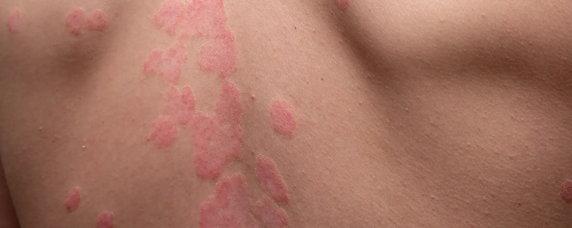 Psoriasis