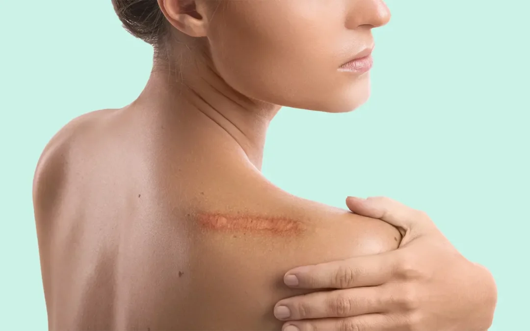 Latest Scar Treatment Innovations for 2026: What’s Coming Next?