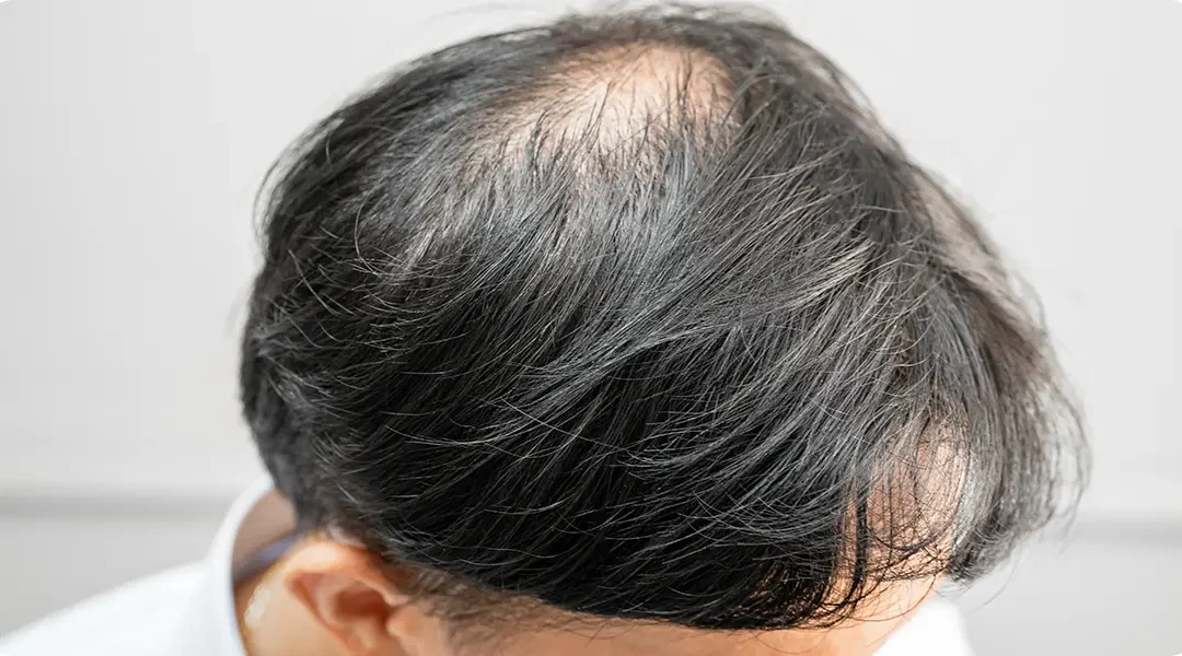 Alopecia and Hormonal Contraception: Can the Pill Trigger Hair Loss?