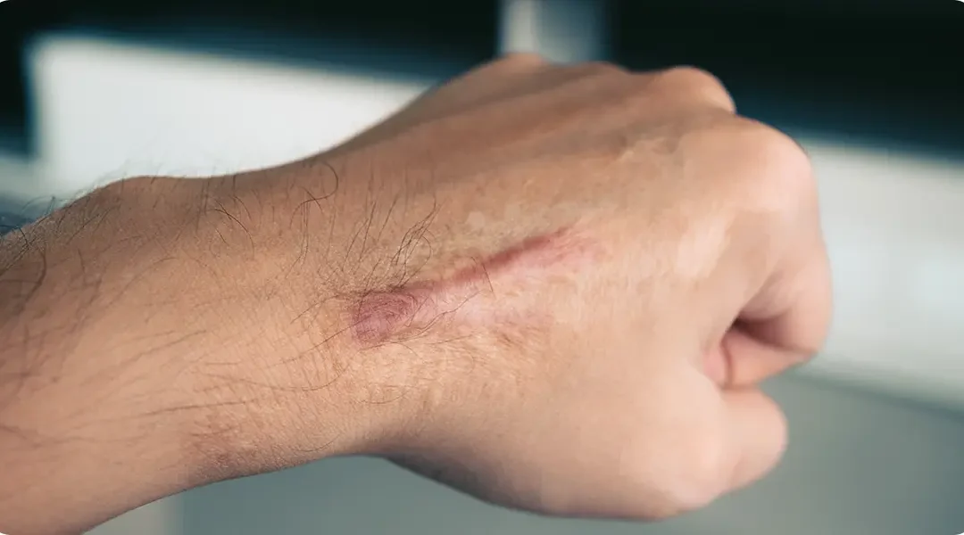 Fillers for Scar Revision: How Hyaluronic Acid Smooths Depressed Scars