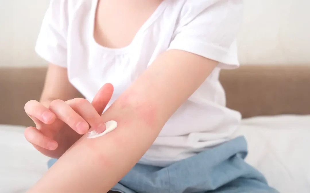Wet Wrap Therapy for Eczema: When It Helps and How to Do It Safely