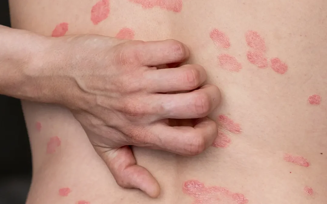 Psoriasis & Immunity: How Immune-Targeting Treatments Actually Reduce Symptoms
