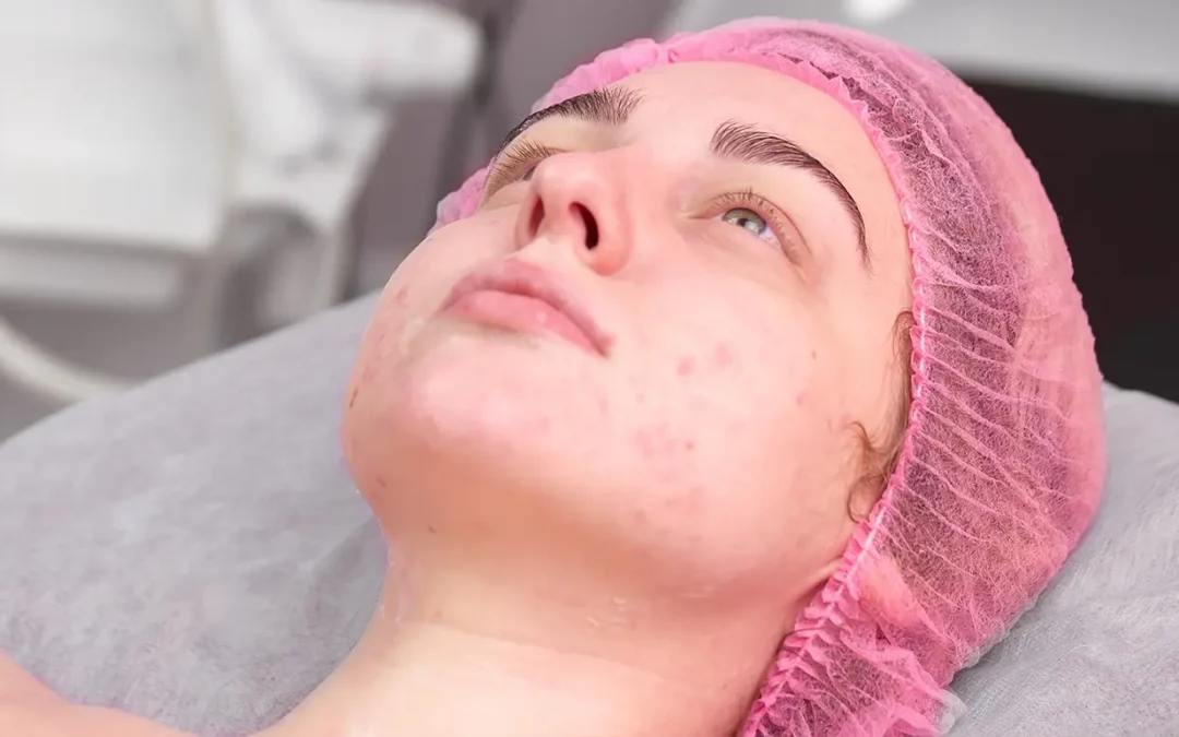 Skin Care & Rosacea Control to Prevent Rhinophyma: What Every Patient Should Know