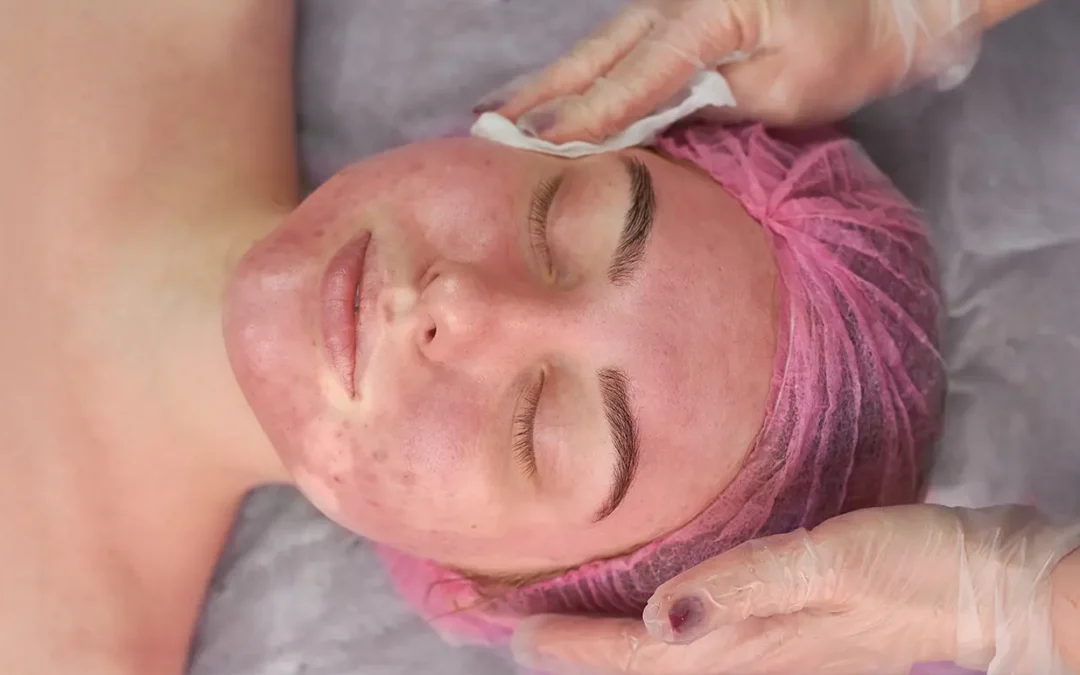 Psoriasis Treatment Failures: Why Some Therapies Stop Working Over Time