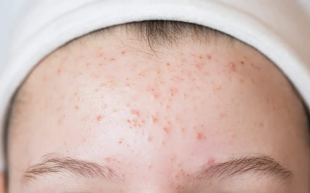 Acne Scars vs Enlarged Pores: How to Tell the Difference & Why It Matters