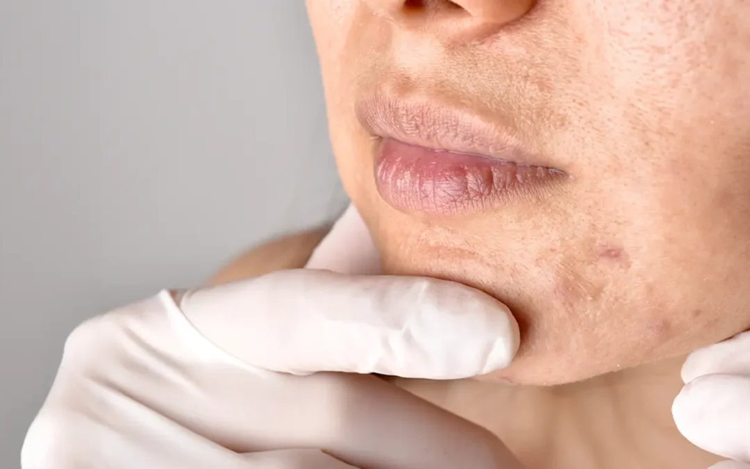 At-Home Acne Scar Treatments: What Works, What Doesn’t & When to Avoid DIY Methods